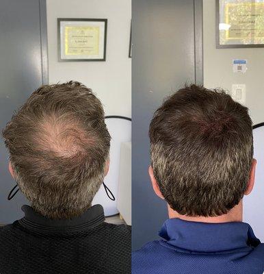 Scalp micropigmentation for men's hair density. Before and after treatments by Edge Scalp Ink in Bethesda, Maryland.