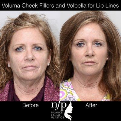 Just one syringe of Voluma was used to augment this patient's cheeks, which helped restore some volume loss in the area of the cheek bone.