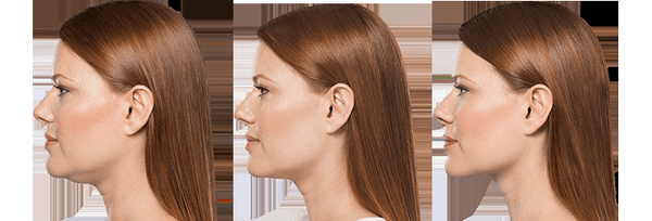 Kybella to reduce double chin!