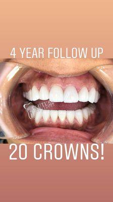 4 Year Follow up on 20 crowns.  Look how natural they look!