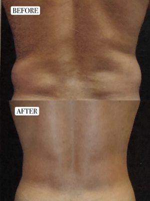 Liposuction of waistline (male patient) (**Procedure performed by Dr. Mirabadi. Individual results may vary.**)