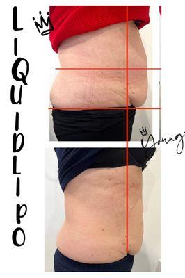 Body wrap using Liquid  Lipo