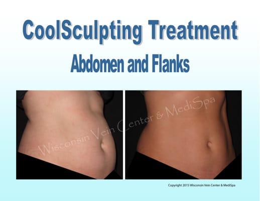 Say goodbye to muffin tops & love handles with no needles, no special diets, no supplements, no surgery, and very little or no downtime!