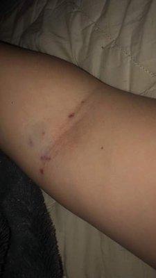 My daughter's arm after the nurse ripped out her IV line out. She was only poked once. The rest is from how hard she ripped the tape off.