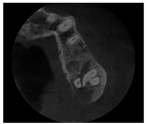 Cone Beam CT showing palatal root fracture