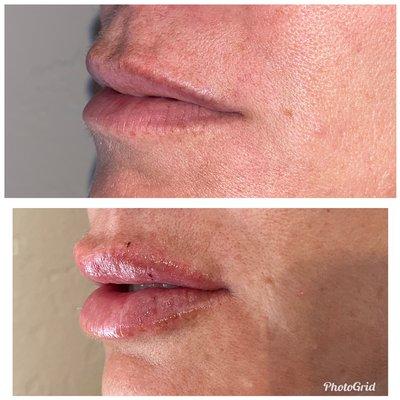 Before/after Restylane Kysse for lips