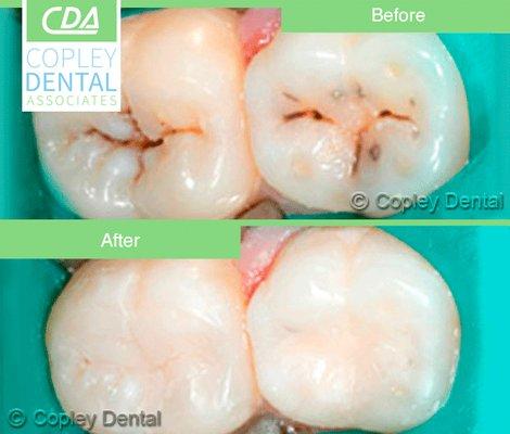 Cosmetic white filling before & after.
 @copleydental 617-536-4020