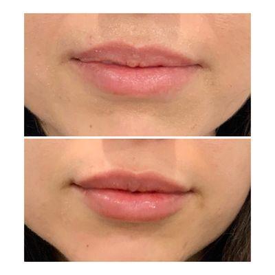 Juvederm Ultra Plus XC Lip Enhancing filler