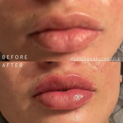 1ml juvederm