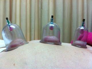 Cupping Treatment helps chronic pain relief and feel better after.