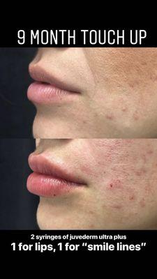 Lip enhancement