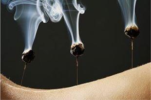 Moxibustion Therapy