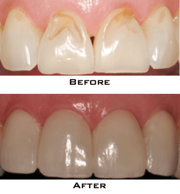 Veneers used to mask teeth defects and improve esthetics