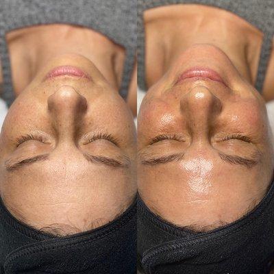 Before and after Signature Hydrafacial