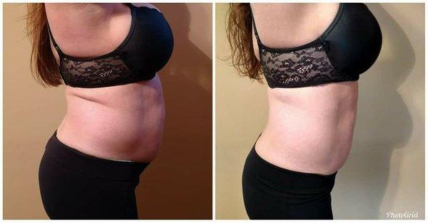 Before & After Picture after 1 package of Laser Lipo Treatments!