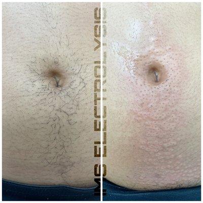 Electrolysis hair removal