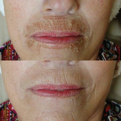 Plasmalift lip line correction at Lakeside Skincare!