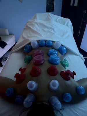 Cupping therapy is important for injuries, lymphatic movement, athletes, and recovery.