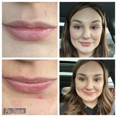 Lip filler