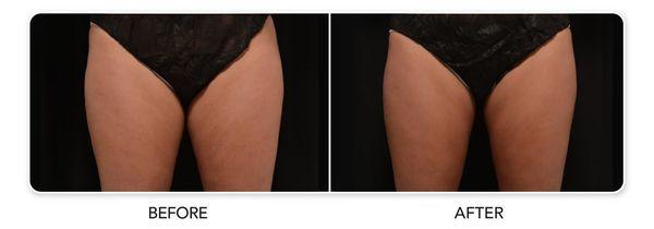 Before and after CoolSculpting® results on female thighs