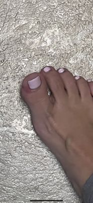 Ingrown toenail/infection