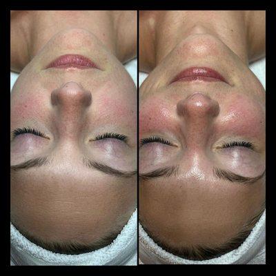 Before and after custom treatment facial