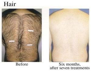 Metamorphosis Laser Hair Removal