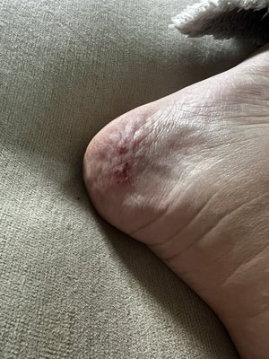 Pedicure injury