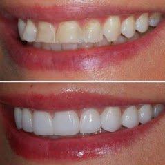 Before and After at NÜVA Smile | Wyckoff, NJ