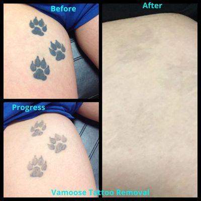 Pico Laser Tattoo Removal is all we do!