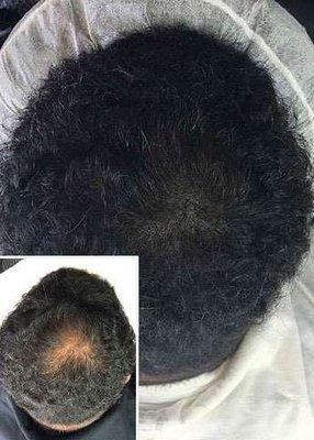 SMP Scalp Micropigmentation