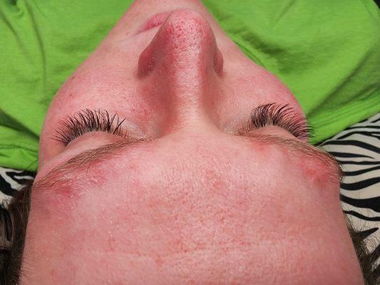 After lashes
And microneedling.