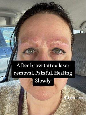 Botched eyebrow tattoo by Barbara Alexis Ink. in Garden City, NY. had to be removed by laser treatments. Awful tattoo work!