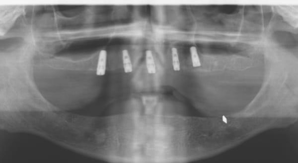 Full Arch All on 4 Concept X-Ray