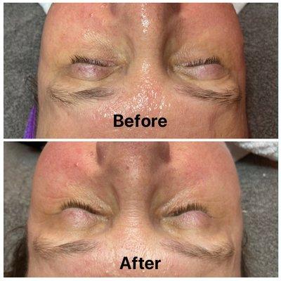 Opti Resurfacing Treatment Facial with Corium Corrective Skincare Growth Factor only