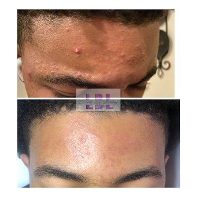 We are excellent to get your rid of your acne!