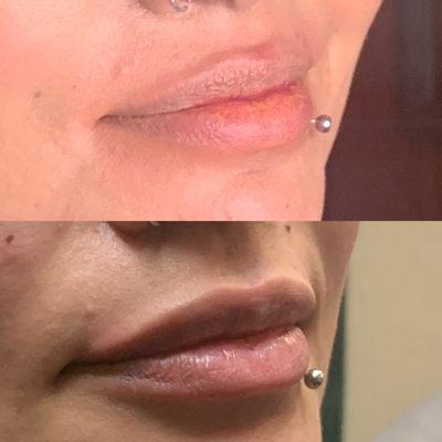 Before and after. 1 syringe of lip filler by our injector Deirdre