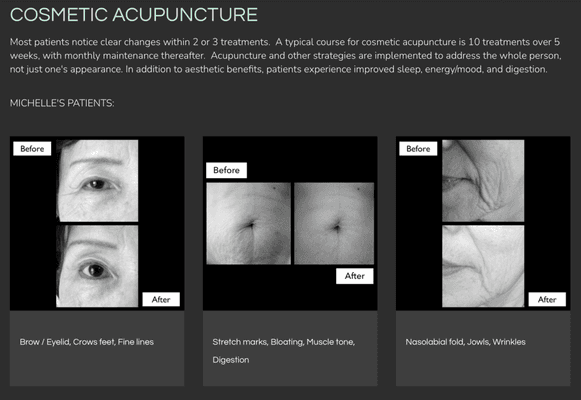 Before and After photos of Michelle's cosmetic acupuncture patients https://michellemching.com/cosmetic