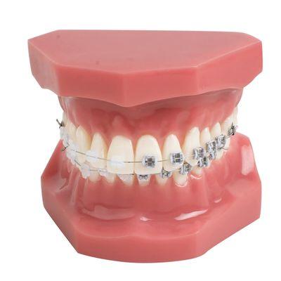 Model with clear and metal braces