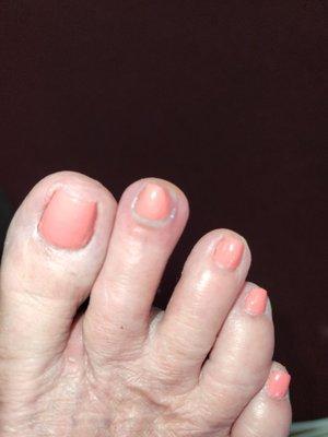 Infected toe,notice the puss. This is only 3 days later.