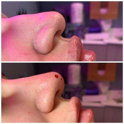 Liquid nose augmentation