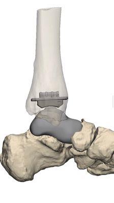 Custom ankle replacement implants. #makeityours.