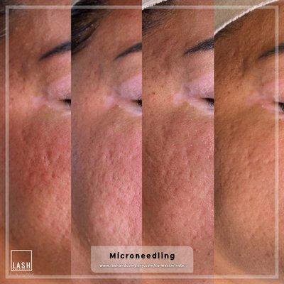 Microneedling