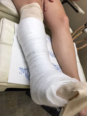 Cast padding being applied for comfort while wearing a cast