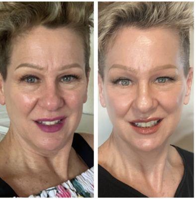 Before/After 1 Procell Stemcell infused Microchanneling Therapy