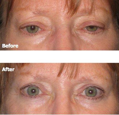 Upper Eyelid Surgery