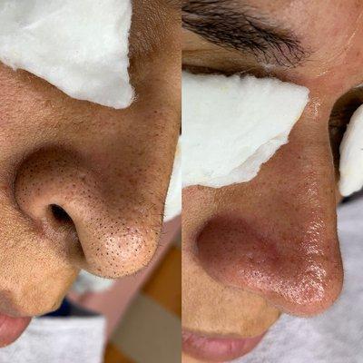 Before and after blackhead extractions