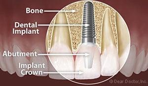 Dental-Implants-Little-Rock-AR