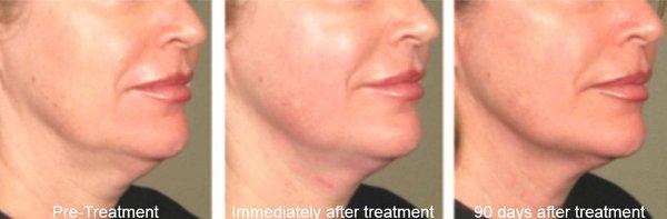 Ultherapy Non-Invasive Treatment