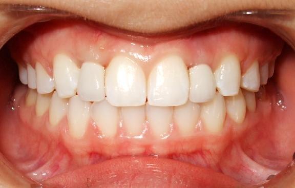 After placement of 2 dental implants